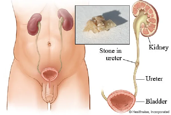 Ureteric Stone