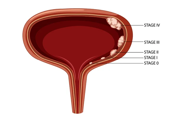 Bladder Cancer