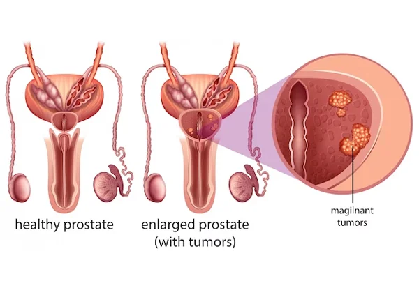 Prostate Cancer
