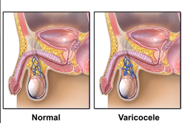 Varicocele Surgery